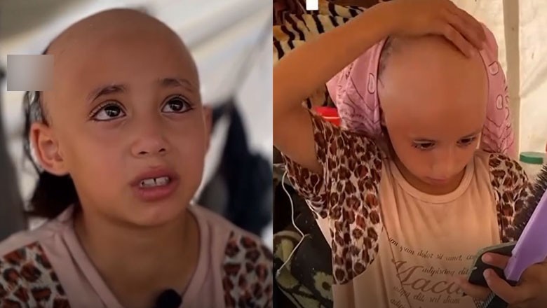 8-year-old Gaza girl loses her hair due to severe mental stress of Israeli attacks