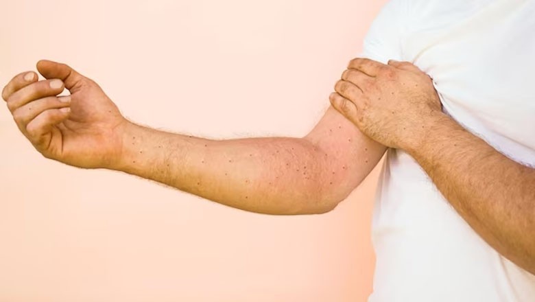 Seventh case of mpox diagnosed in Pakistan