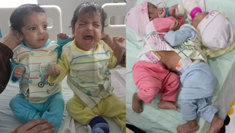 Karachi doctors successfully separate conjoined twins of Naushahro Feroze